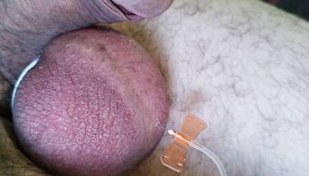 Saline Injected Balls