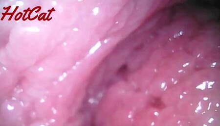 Endoscopic ♥vaginal observation