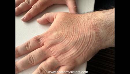 Arm & hand trampling