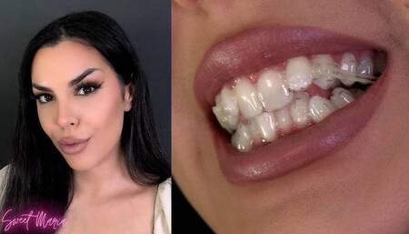Mouth tour with my aligners on! ~ Sweet Maria