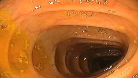 In the medical center for my first double endoscopy of the stomach and intestines 720HD