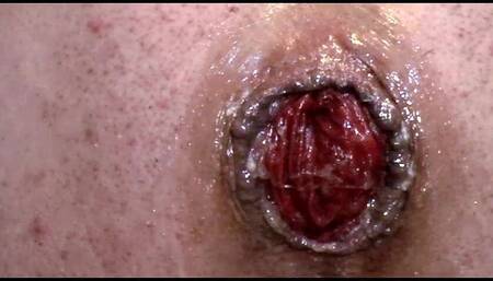 Huge Anal Prolapse Pumping