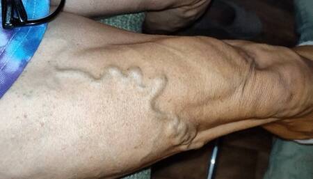 Tempest post surgery