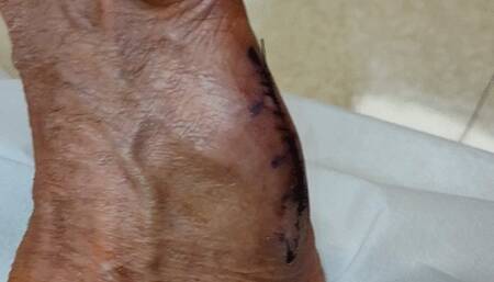 Tempest showing foot after cast removed