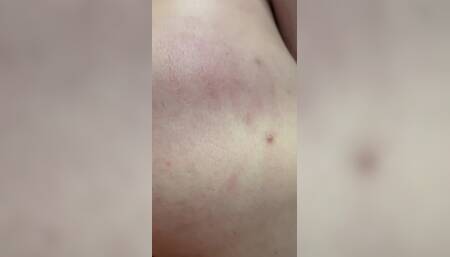 Not Blistered or Bruised yet