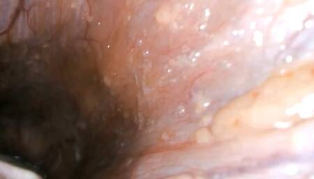 An Inside Look at Digestive Health: A Journey through the Gastrointestinal Tract Captured by PillCam Technology 720MP4