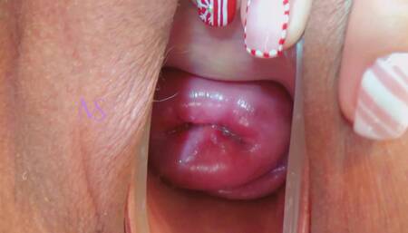 Cervix Uterine