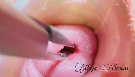 Cervix Without Extreme Dilation