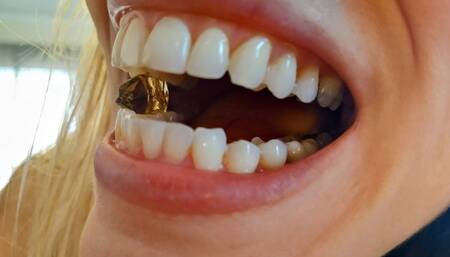 Gummy bear clear views in mouth deal