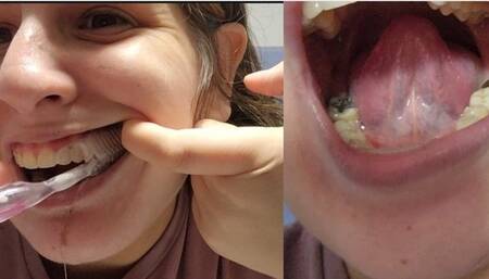 Cleaning My Dirty Blackened Teeth – Watch Me Remove Stuck Food and Restore the Shine