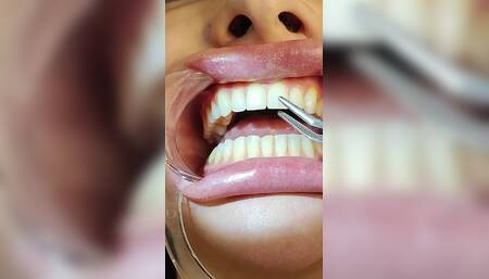 Complete Teeth Exam by the Dentist, Installation of Jewelry