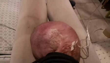 Filling up with 0,500liter glucose 10%